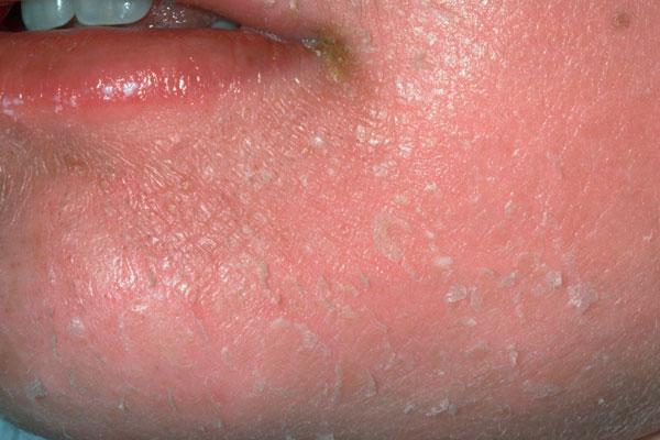 streptococcal skin