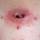 Abscess Abscess