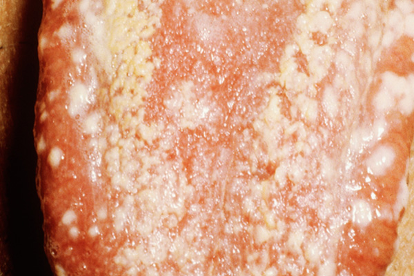 Candidiasis of the Tongue