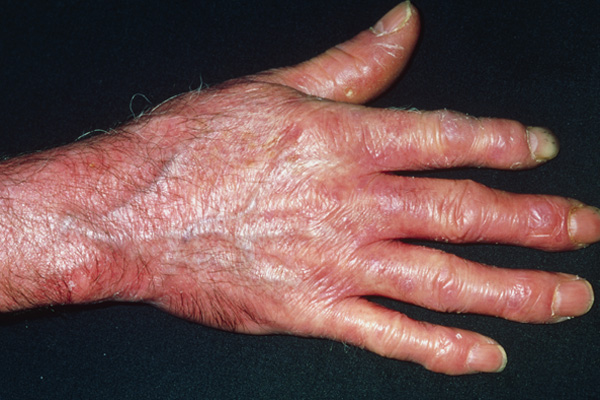 scleroderma what is it