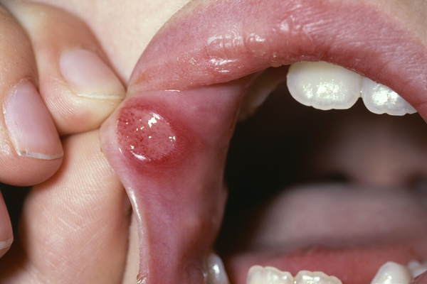 Mouth ulcers - NHS Choices