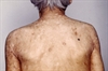 Nutritional Deficiencies