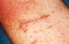 Peripheral Artery Disease