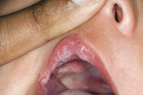 mouth yeast infection