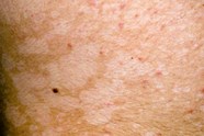 Skin Yeast Infection Pictures Photos