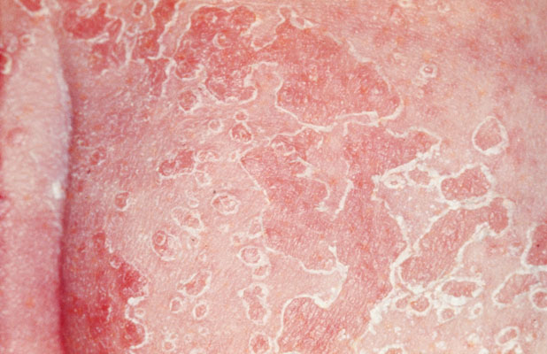 Cutaneous Candidiasis As Related To Dermatitis Pictures