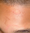 Pediatric facial rashes