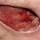 Deep ulcer Deep ulcer
