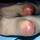 Developing pressure ulcers Developing pressure ulcers