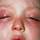 Allergic conjunctivitis Allergic conjunctivitis