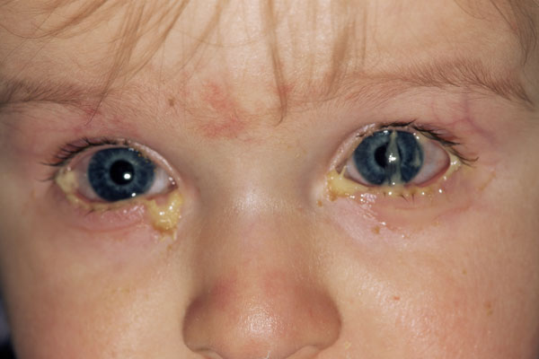 conjunctivitis