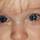 Bacterial conjunctivitis Bacterial conjunctivitis