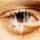 Purulent conjunctivitis Purulent conjunctivitis