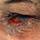 Chronic conjunctivitis Chronic conjunctivitis