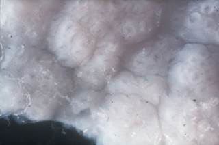 In celiac disease, the noramally ridged surface of the small intestine mucosa becomes flattened. In celiac disease, the noramally ridged surface of the small intestine mucosa becomes flattened.