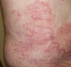 Painless, annular lesions
