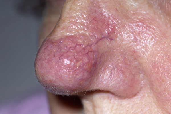 Rhinophyma - WebMD