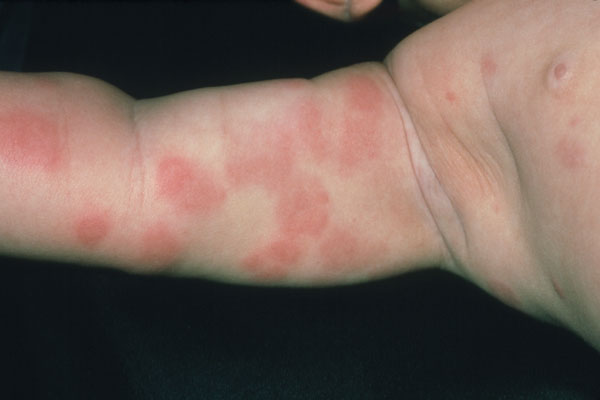 What Food Allergies Cause Skin Rashes