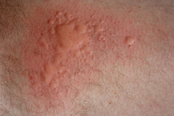 food allergies skin rash