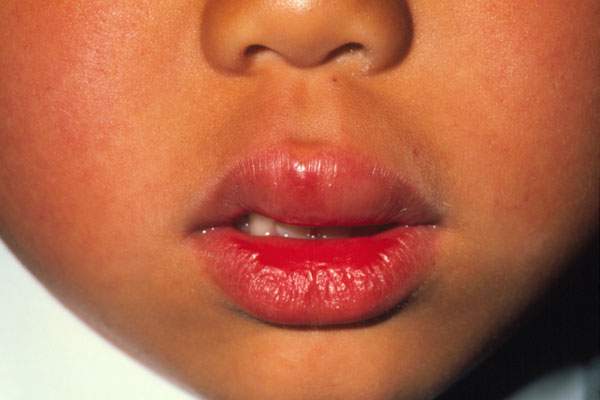 allergic reaction on lip
