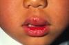 Food Allergies Food Allergies