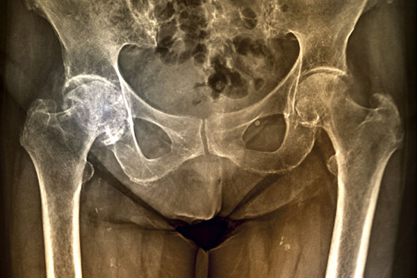 Types of Arthritis