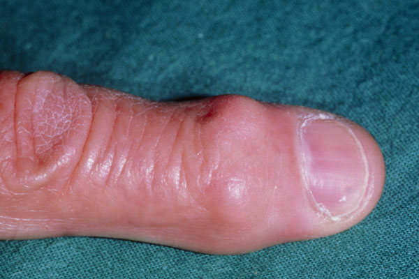 What Causes Nodules On Finger Knuckles