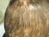 Hair loss in an adult and a child