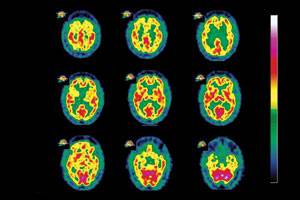 Brain scan shows diffuse Lewy body dementia. Brain scan shows diffuse Lewy body dementia.