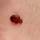 Bed bug Bed bug