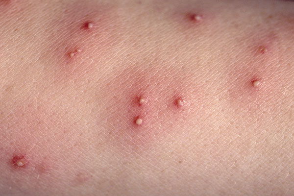 Insect bites and stings - Symptoms - NHS Choices