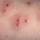 Fire ant stings Fire ant stings