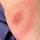 Lyme disease Lyme disease