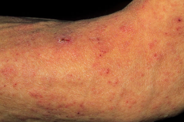 Scabies 3 Picture Image on MedicineNet.com