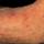 Scabies Scabies
