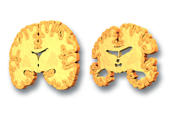 Brain tissue loss