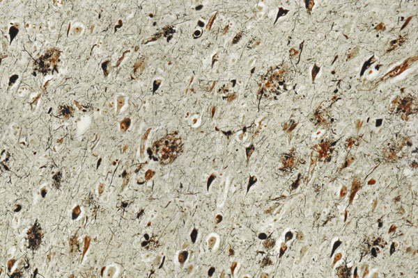 Amyloid plaque