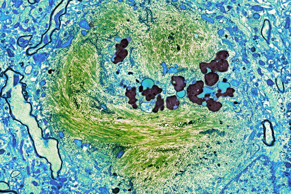 Neurofibrillary tangle