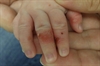 Infant hand and foot blisters