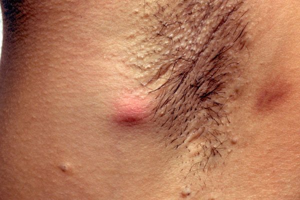 Hidradenitis suppurativa - Wikipedia