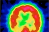 Treatment guidelines for Alzheimertype dementia