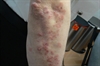 Pruritic rash develops after diet change Itchy back papules with a white, flaky scale