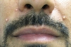 Pustular facial eruptions