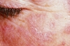Derm Dx: A confluent swollen itchy symmetrical rash on the cheeks....