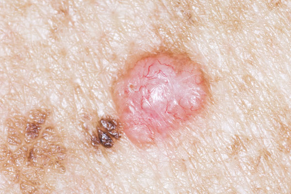 Skin Cancer Growth