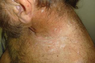 Neck rash coupled with refractory neuropathic pain Neck rash coupled with refractory neuropathic pain