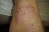 Red, itchy scaling plaques on a toddler Hyperpigmented patch with hypertrichosis
