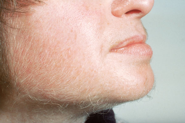 What causes hair to grow on a woman's chin and neck?