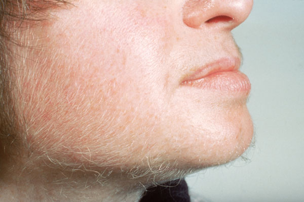 Hirsutism