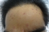 Derm Dx: Painless red bumps on face and body in a man with HIV